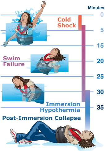 Illustration of the stages of hypothermia. 